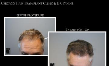 PANINE, MD - Chicago Hair Transplant Clinic FUE Patient Results with 2,758 Grafts