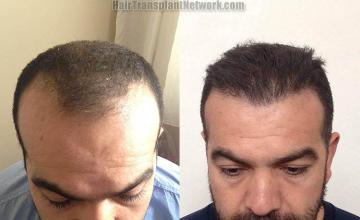 Front view - Before and after hair transplant surgery result images