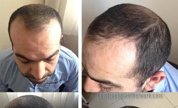 Hair restoration procedure before pictures