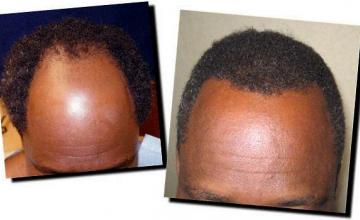 Hair restoration procedure results