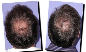 Hair restoration procedure results