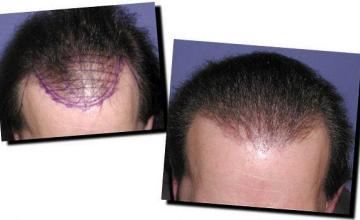 Hair restoration procedure results