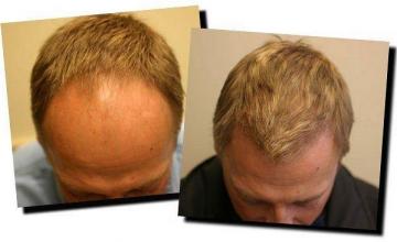 Hair restoration procedure results