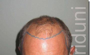 Hair restoration procedure results