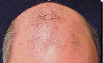 Hair restoration procedure results