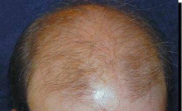 Hair restoration procedure results