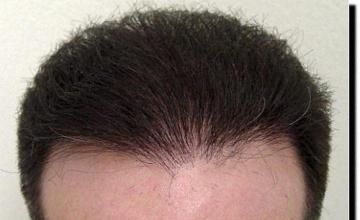 Hair restoration procedure results