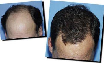 Hair restoration procedure results