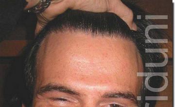 Hair restoration procedure results