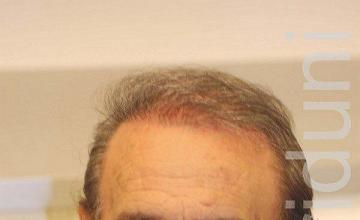 Hair restoration procedure results