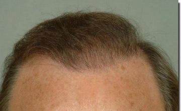 Hair restoration procedure results