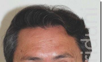 Hair restoration procedure results