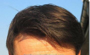 Hair restoration procedure results