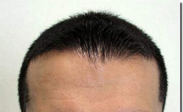 Hair restoration procedure results