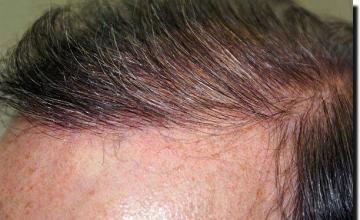 Hair restoration procedure results