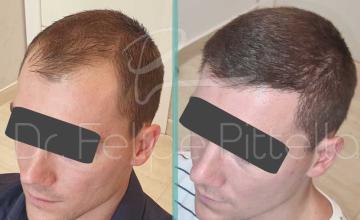 Left view before and after hair transplant surgery