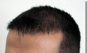 Hair restoration procedure results