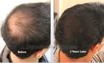 Right view of patient before and after