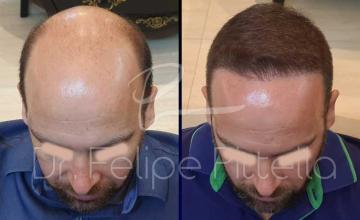 Top view of patient, before and after FUE surgery