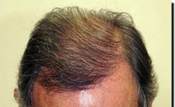 Hair restoration procedure results