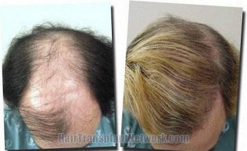 Hair restoration procedure results