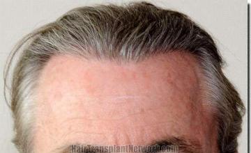 Hair restoration procedure results