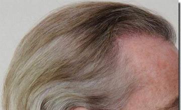 Hair restoration procedure results