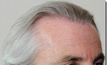 Hair restoration procedure results