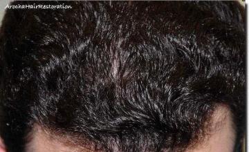 Hair restoration procedure results