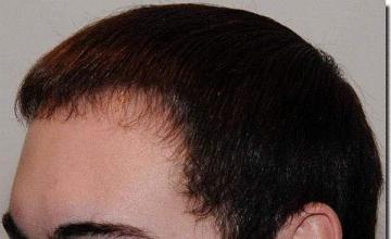 Hair restoration procedure results