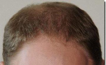 Hair restoration procedure results