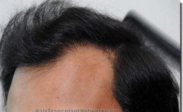 Hair restoration procedure results