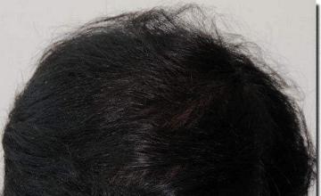 Hair restoration procedure results