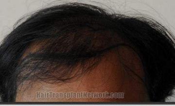 Hair restoration procedure results