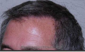 Hair restoration procedure results