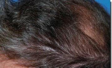 Hair restoration procedure results