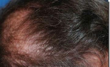 Hair restoration procedure results