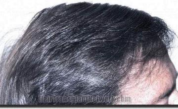 Hair restoration procedure results