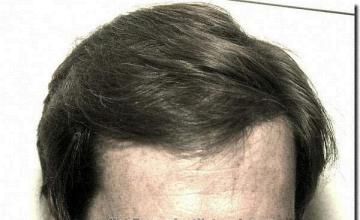 Hair restoration procedure results