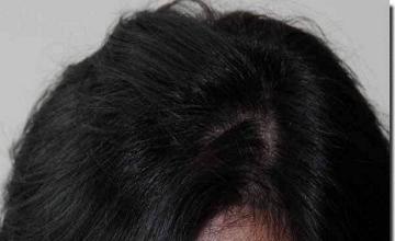 Hair restoration procedure results