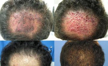 Before and after artificial hair removal and transplant