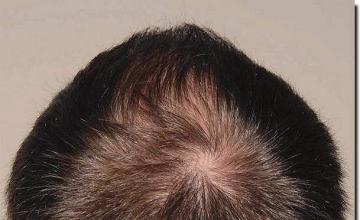 Hair restoration procedure results