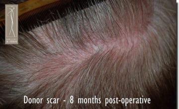 Hair restoration procedure results