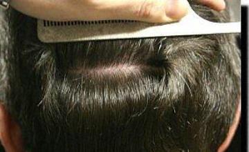 Hair restoration procedure results