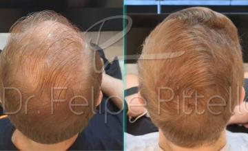 Back of patient - before and after 8122 FUE hair transplant surgery