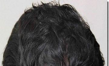 Hair restoration procedure results