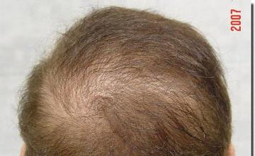 Hair restoration procedure results