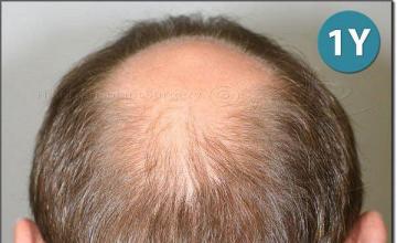 Hair restoration procedure results
