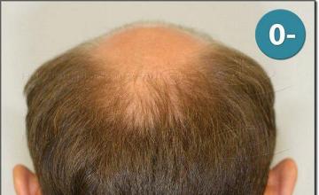 Hair restoration procedure results
