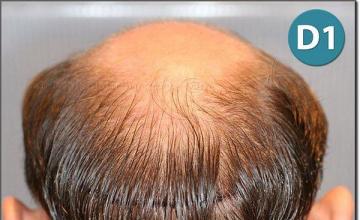 Hair restoration procedure results